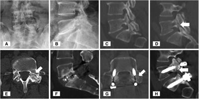 Case Report: Lumbar spondylolisthesis with unilateral pedicle cleft and contralateral spondylolysis: a report of two cases and literature review